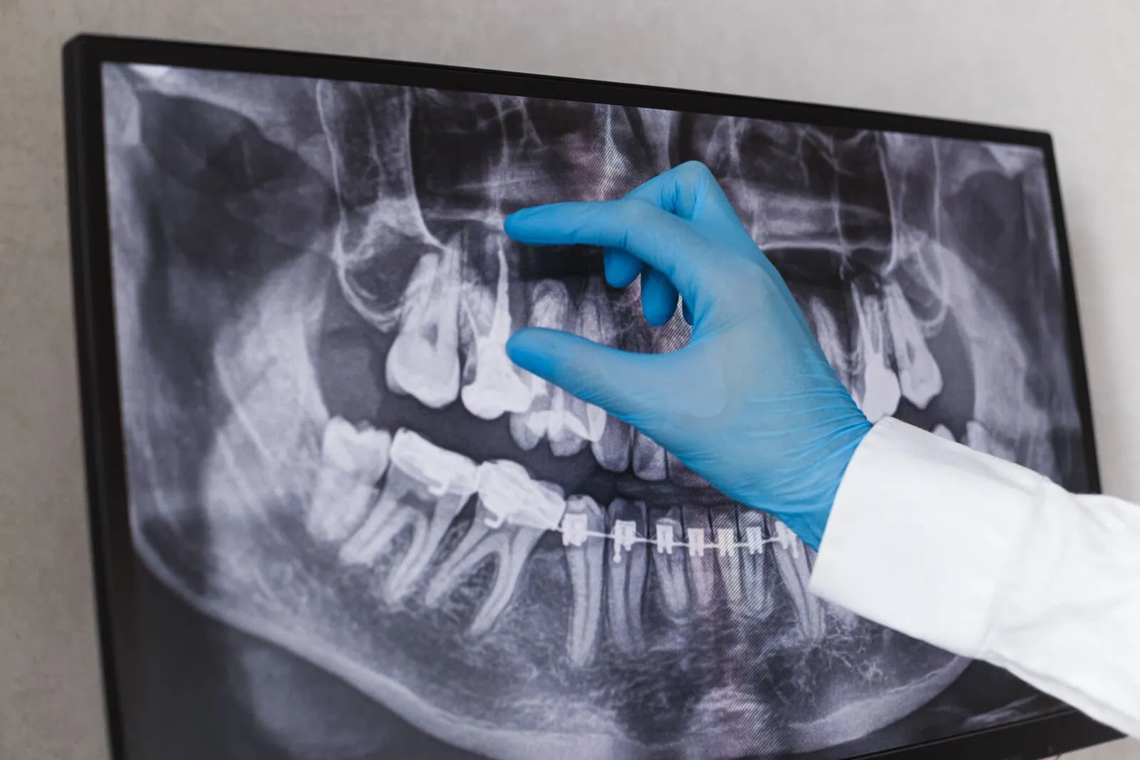 Root canal treatment New Orleans
