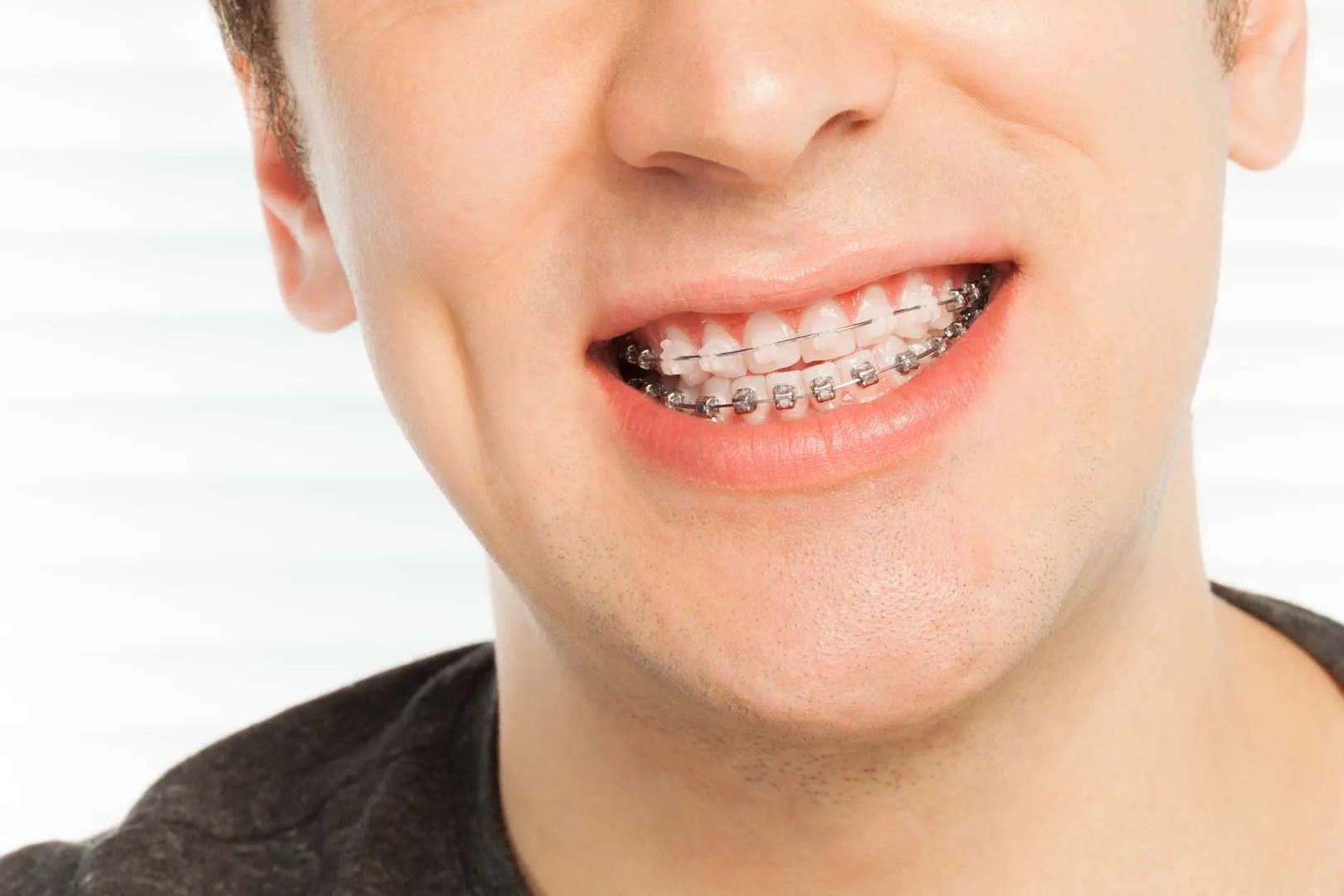 Fastbraces accelerated orthodontics New Orleans